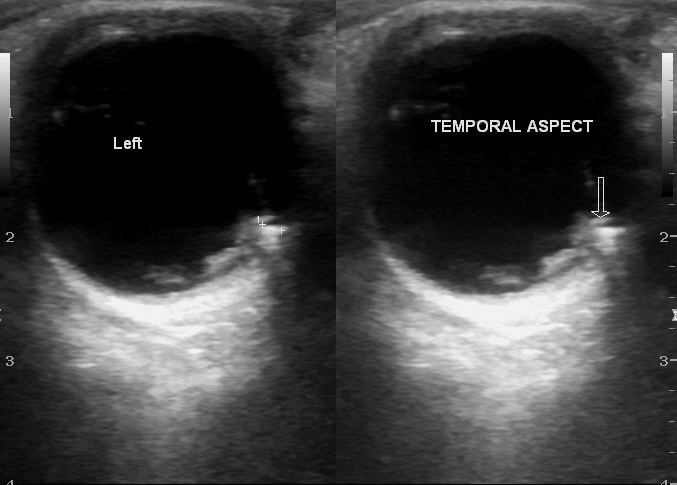 Dị vật nội nhãn (Ocular foreign body)