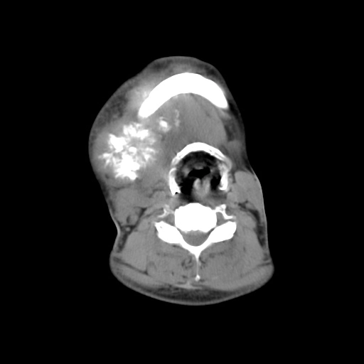 Osteosarcoma xương hàm (Gnathic osteosarcoma)