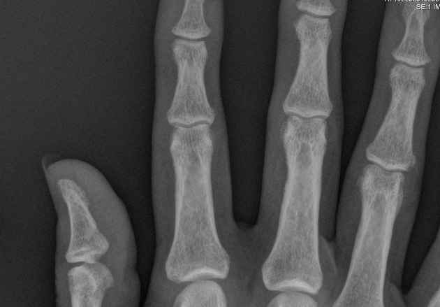 Loạn dưỡng xương do thận (Bệnh xương do ure huyết cao) (Renal osteodystrophy)