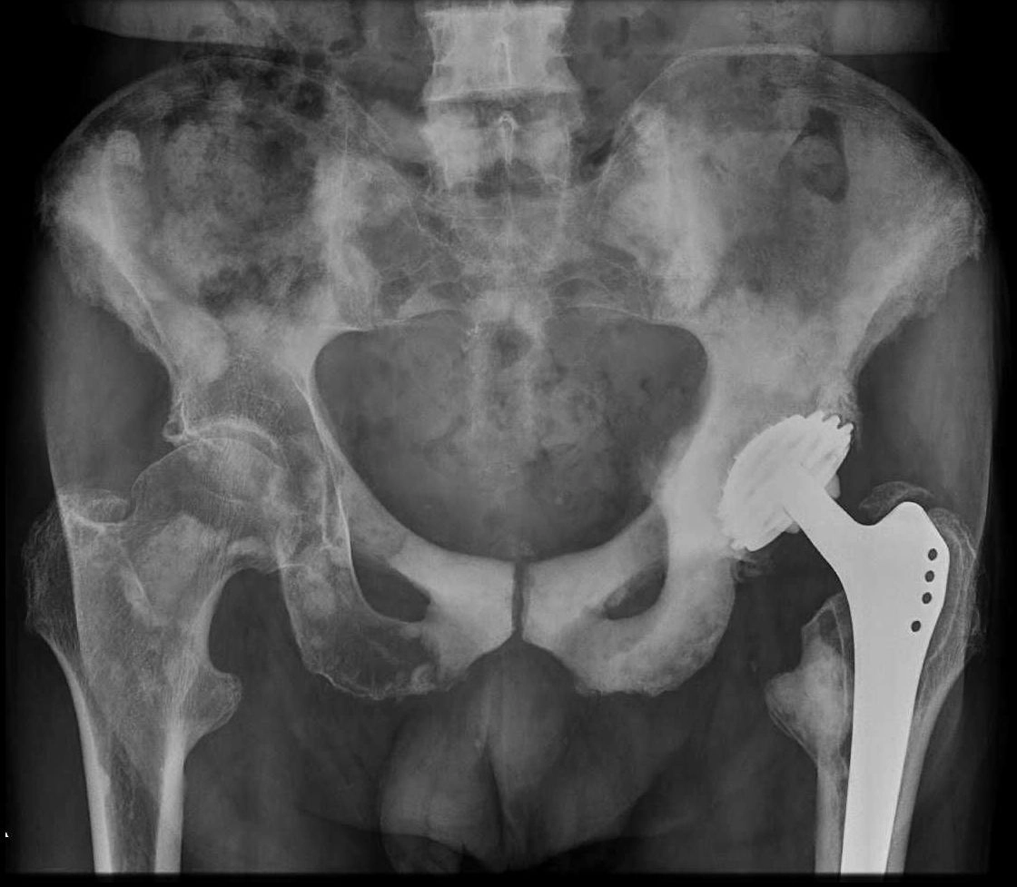Di căn đặc xương (Sclerotic bone metastases)