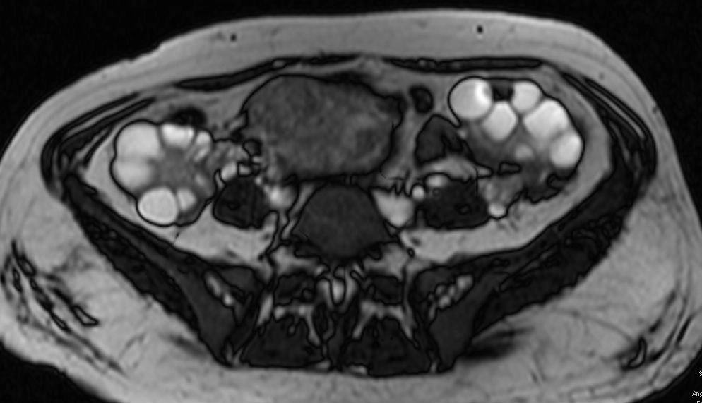 Nang hoàng tuyến (Theca lutein cyst)