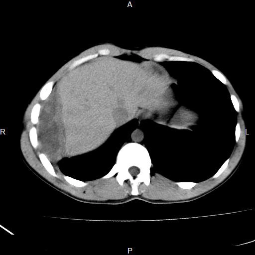 Tràn mủ màng phổi xuyên qua thành ngực (Empyema Necessitans)