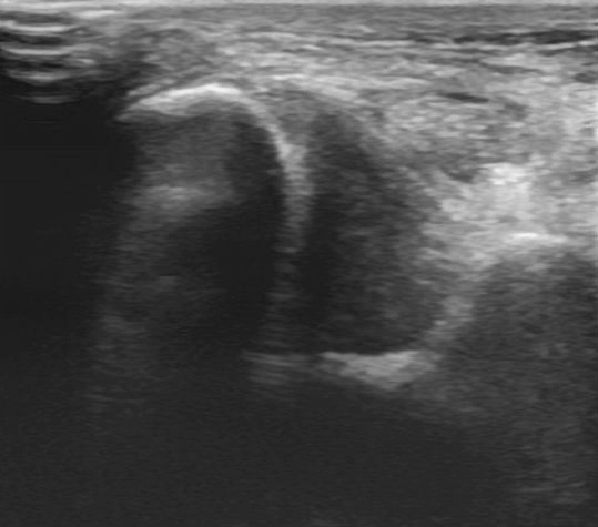 Tổn thương dây chằng delta cổ chân (Deltoid ligament injuries) 