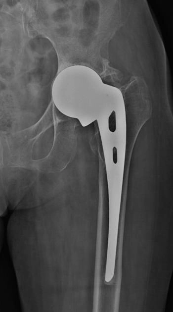 Lún ổ cối (Acetabular protrusion)