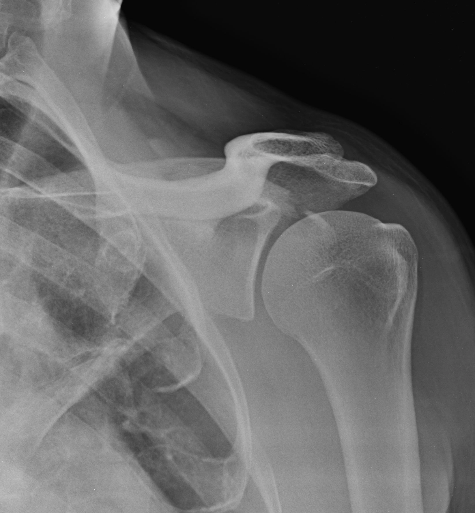 Gãy mỏm quạ xương bả vai (Coracoid process fracture)