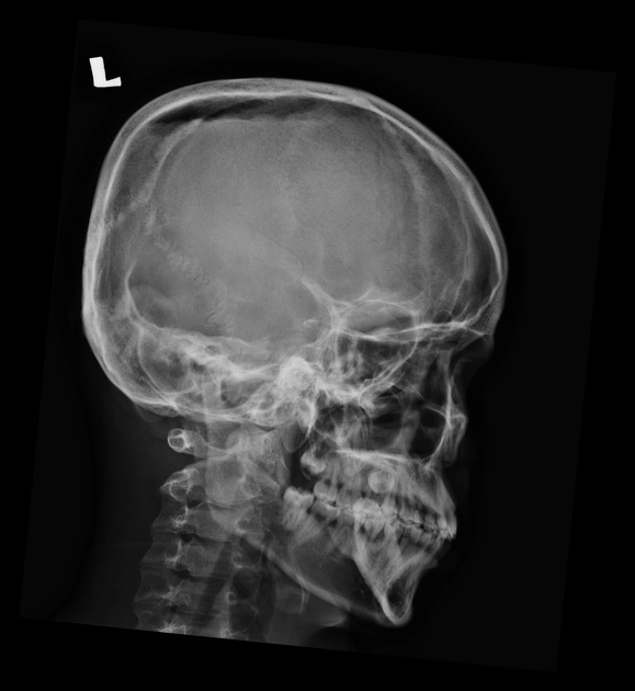 Tràn khí nội sọ (Pneumocephalus)