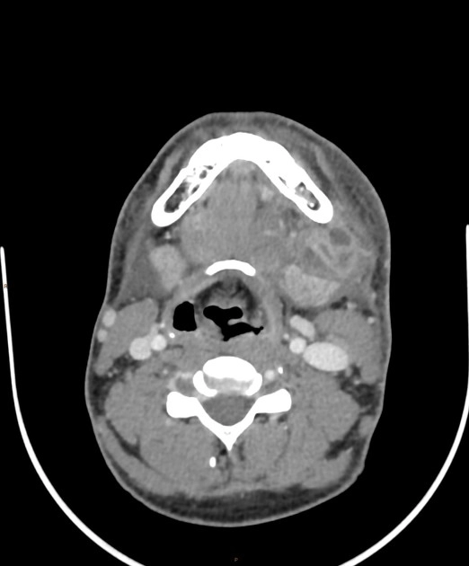 Hạch viêm ở cổ (Cervical adenitis)