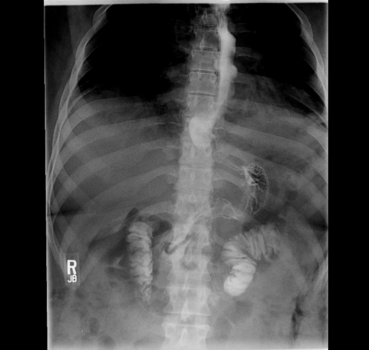 Phẫu thuật cắt dạ dày hình ống (Sleeve gastrectomy)