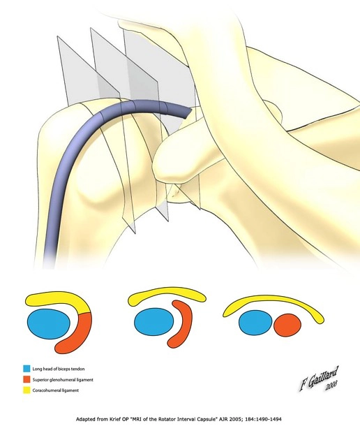 Trật gân cơ nhị đầu (Biceps Tendon Dislocation)