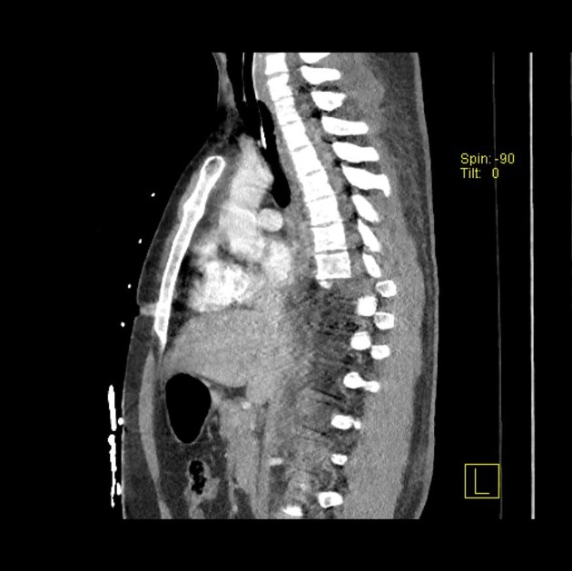 Gãy trật cột sống ngực thắt lưng (Thoracic spine fracture-dislocation)