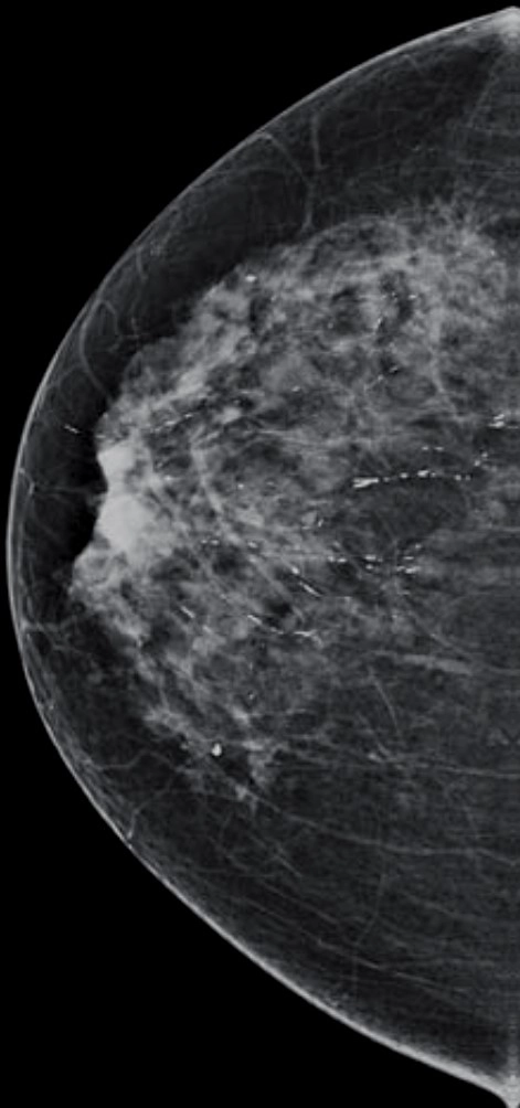 Vôi hóa dạng tiết dịch (secretory calcifications)
