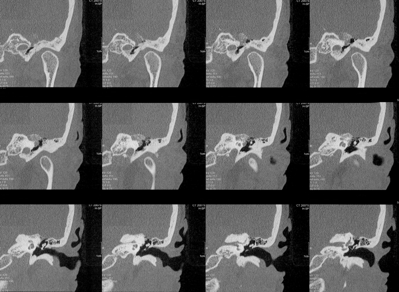 Dị dạng mạch máu tĩnh mạch của thần kinh mặt (Venous vascular malformations of the facial nerve)