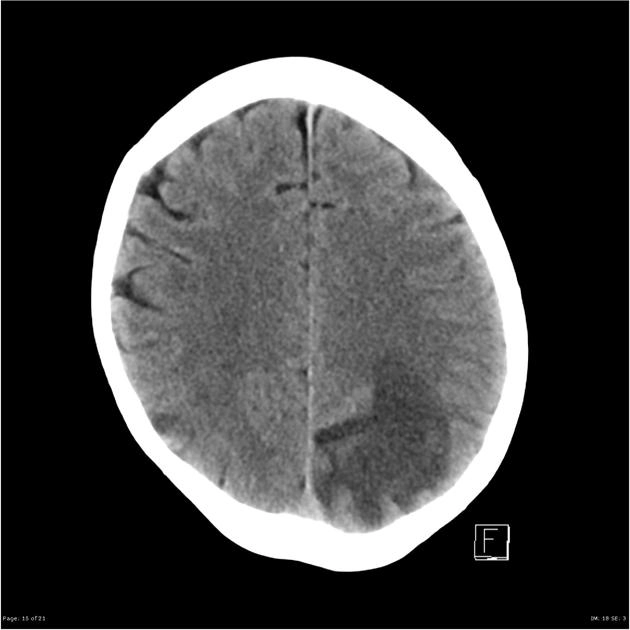 Nhiễm nấm Aspergillus hệ thần kinh trung ương (CNS Aspergillosis)