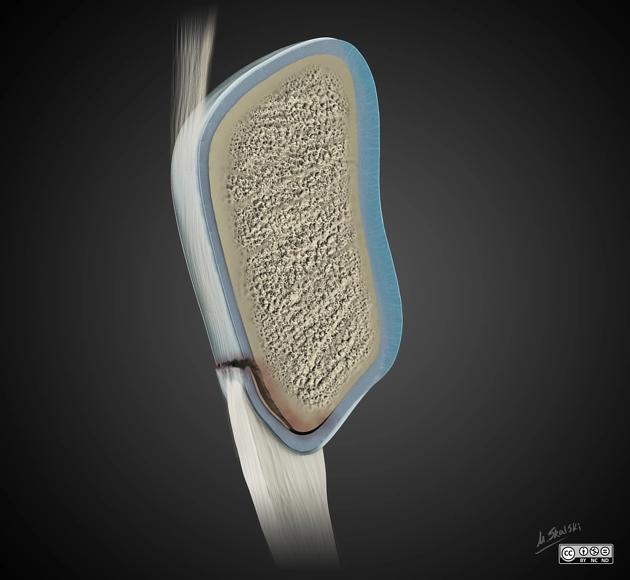 Gãy bong xương bánh chè (Patellar sleeve fracture)