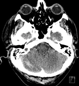 Xuất huyết tiểu não từ xa (Remote Cerebellar Hemorrhage - RCH)