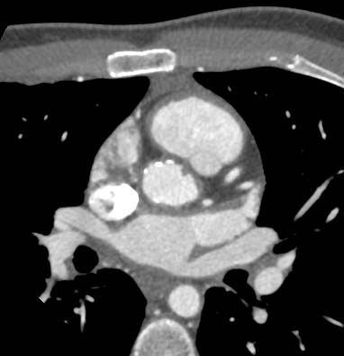 Bệnh động mạch vành (Coronary Artery Disease - CAD)