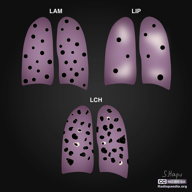 Viêm phổi kẽ dạng lympho (Lymphoid interstitial pneumonia - LIP)