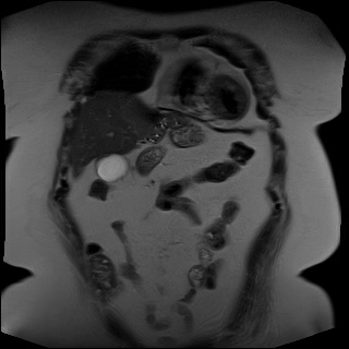 Ung thư đường mật trong gan (Intrahepatic Cholangiocarcinoma - ICC)