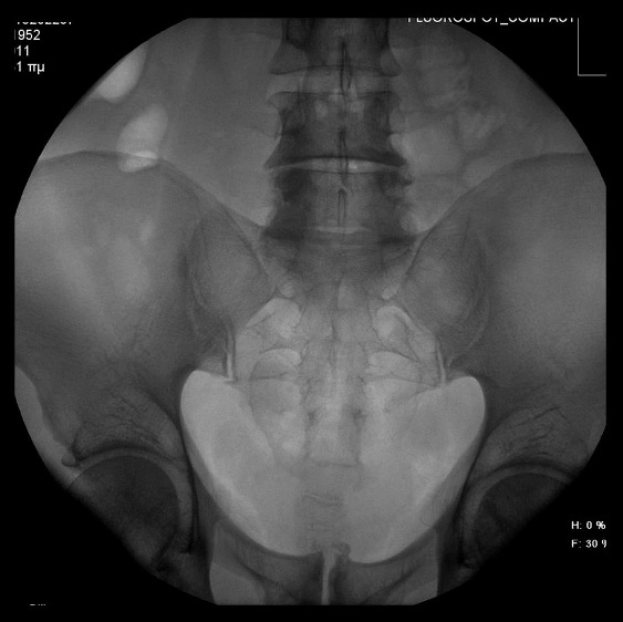 Túi thừa bàng quang (Urinary bladder diverticulum)
