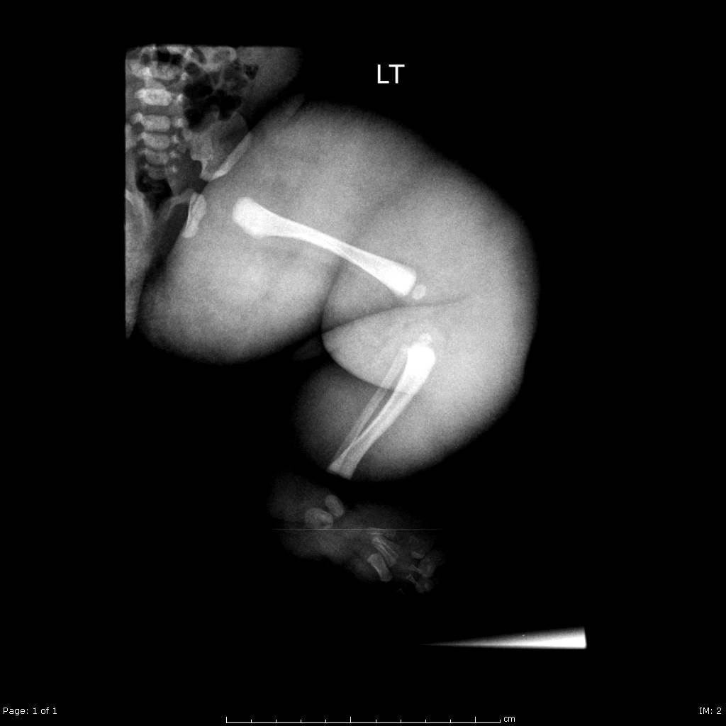 U nội mô mạch máu (Hemangioendothelioma)