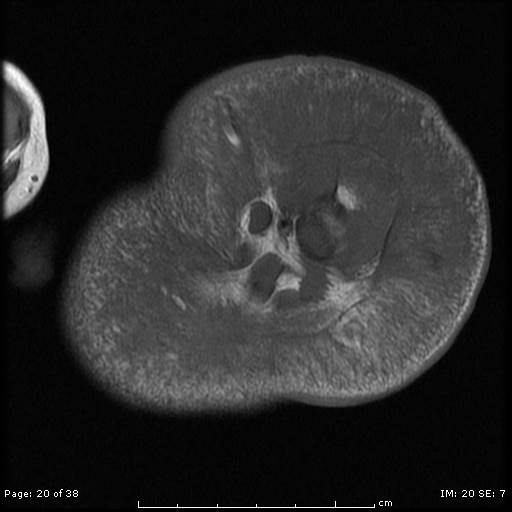 U nội mô mạch máu (Hemangioendothelioma)