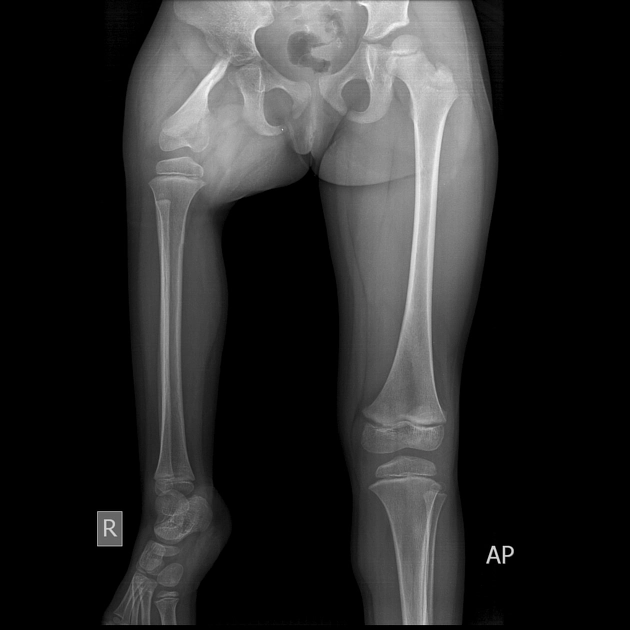 Khiếm khuyết đầu trên xương đùi bẩm sinh (Proximal Femoral Focal Deficiency - PFFD)