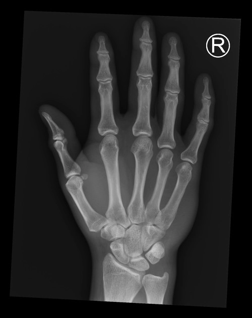 Gãy xương nguyệt (Lunate fracture)