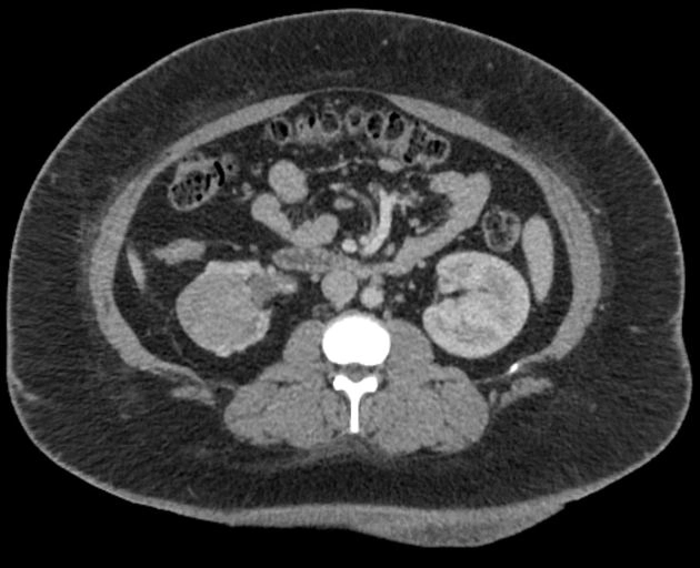 U tuyến hậu thận (Metanephric Adenoma - MA)