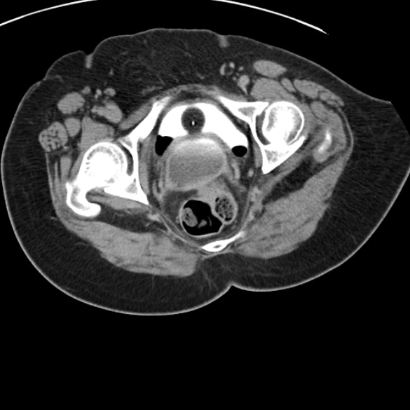 Rò niệu quản âm đạo (Ureterovaginal fistula)