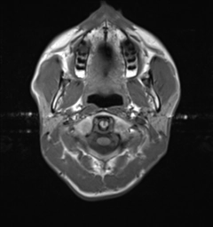 U hạt cholesterol (Cholesterol granulomas)