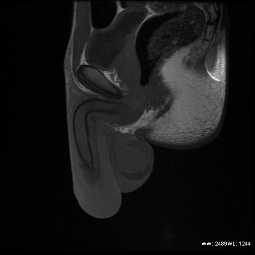 Gãy dương vật (Penile fracture)