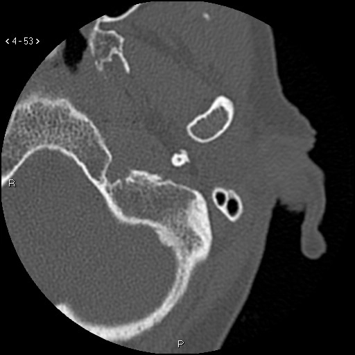 Xơ hóa ống tai ngoài đoạn trong (Medial canal fibrosis)
