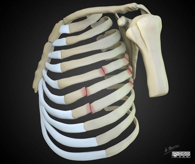 Mảng sườn di động (Flail chest)