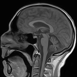 Bệnh não do virus JC (JC Virus Encephalopathy)