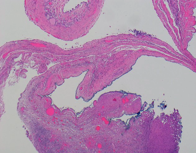 U tuyến giáp buồng trứng (Struma ovarii)