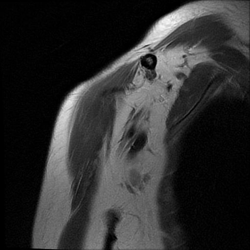 Gãy mỏm cùng vai (Acromial fracture)