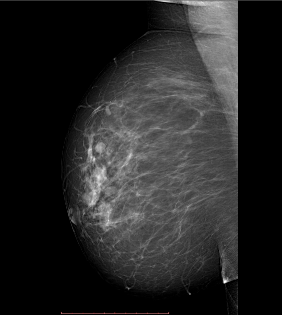 BI-RADS 3 (Breast imaging-reporting and data system (BI-RADS) assessment category 3)