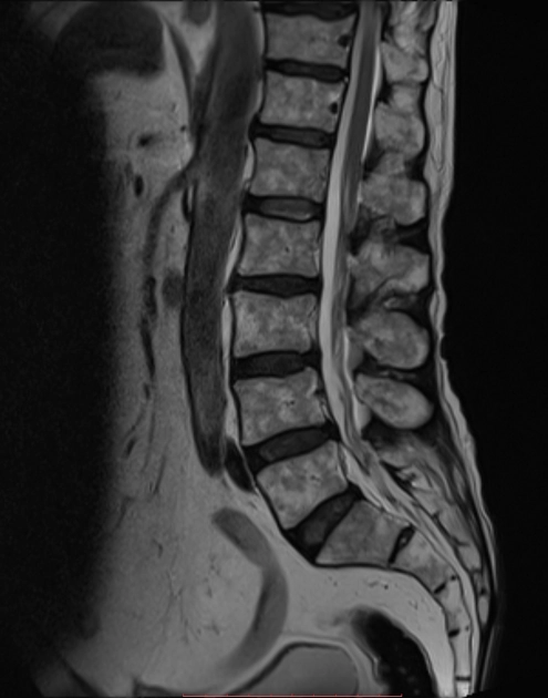 Lắng đọng mỡ khu trú thân sống (Focal fatty deposits in bone marrow)