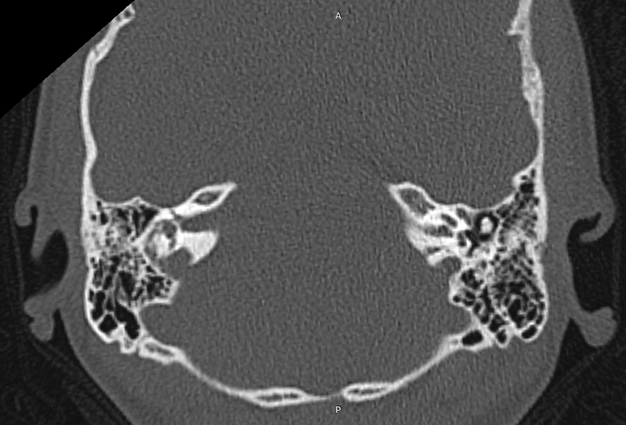 Vòm tĩnh mạch cảnh hở (Dehiscent jugular bulbs)