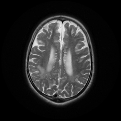 Các biểu hiện ở não của bệnh mucopolysaccharidoses (Cerebral manifestations of mucopolysaccharidoses)