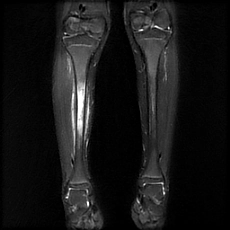 Lỗ rò xương trong viêm xương (Cloaca)