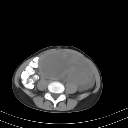 U Dysgerminoma (Ovarian dysgerminoma)
