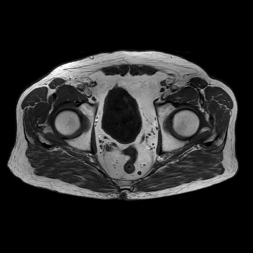 Di căn túi tinh (Seminal vesicle invasion)
