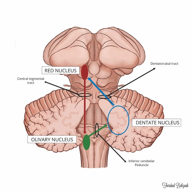 Thoái hóa nhân trám phì đại (Hypertrophic Olivary Degeneration - HOD)