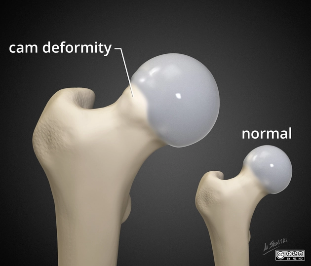 Hội chứng kẹt (chẹn) xương đùi-ổ cối (Femoroacetabular Impingement - FAI)