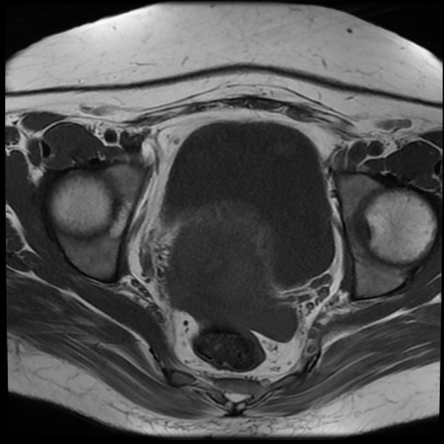 Nhiễm Actinomyces vùng chậu (Pelvic actinomycosis)