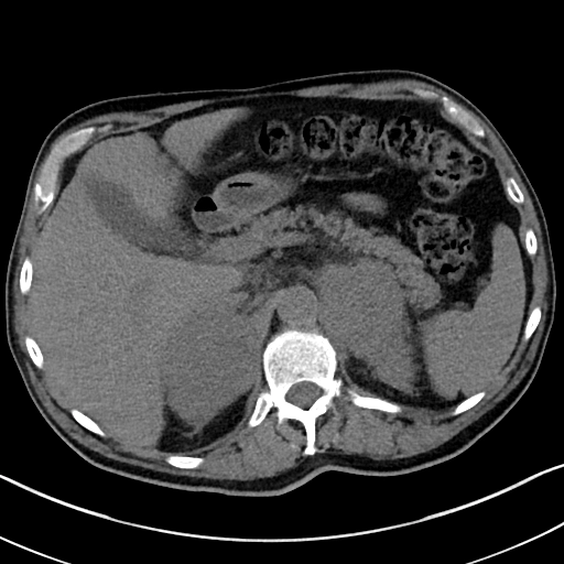 U lymphoma nguyên phát tuyến thượng thận (Adrenal lymphoma)