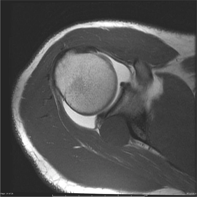 U nang hạch ở khuyết gai-ổ chảo (Spinoglenoid notch ganglion cyst)