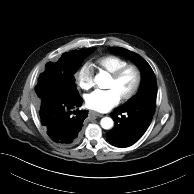 Nốt di căn màng phổi (Solid Pleural Metastases)