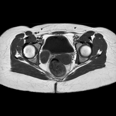Phù buồng trứng (Massive ovarian edema)